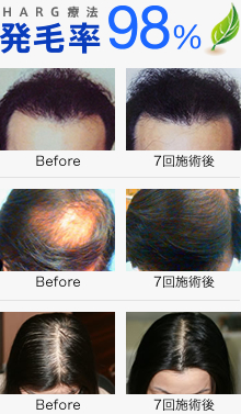 発毛率98%
